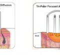 bipolar-and-tripolar delovanje radiofrekvence