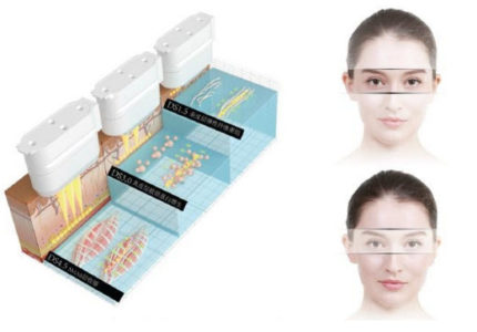 HIFU – nova dimenzija lepote - slika 7